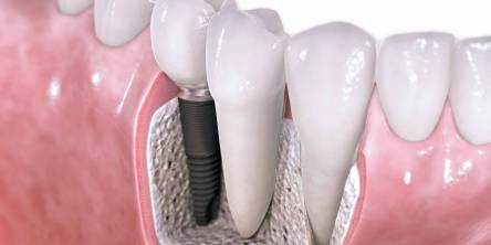 Dental Implants