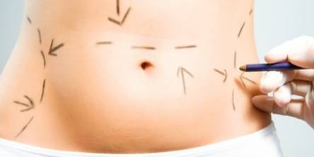 Liposuction