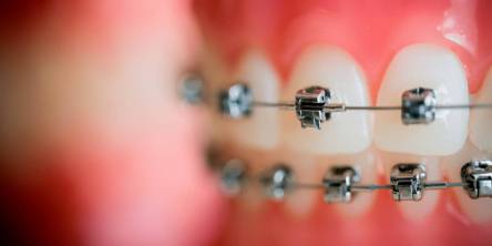 9 Facts About Damon Braces That You Should Be Aware Of