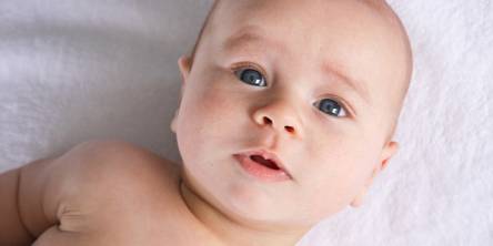 baby torticollis