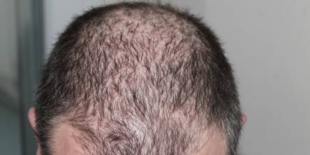 Hair Loss Treatment