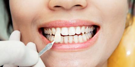 What is the Difference Between Direct and Indirect Veneers?