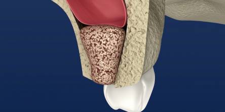 What to Know About Sinus Lift