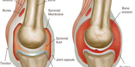 Lifestyle and Easy Home Remedies for Arthritis