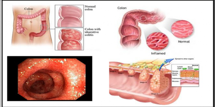 Ulcerative colitis Treatment in Ayurveda with Ayurvedic Medicines